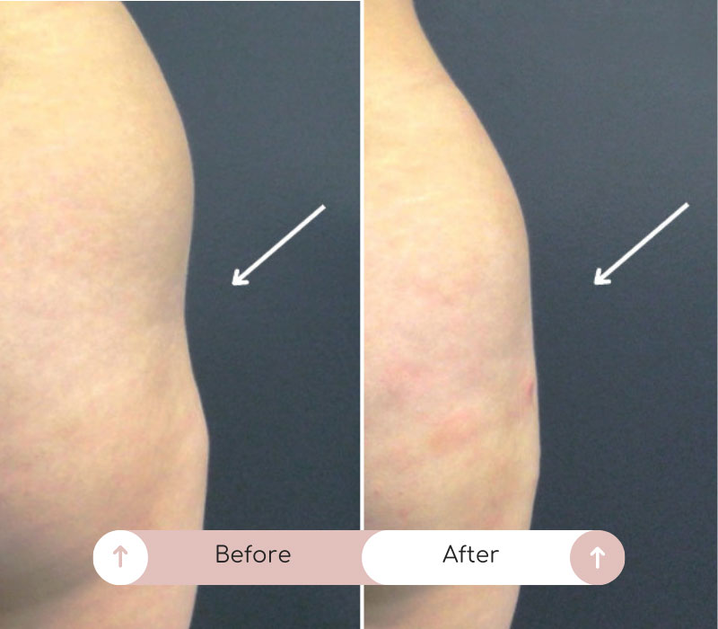 Sculptra Buttocks Lift Hip Dips Correction In Nyc Studiomd